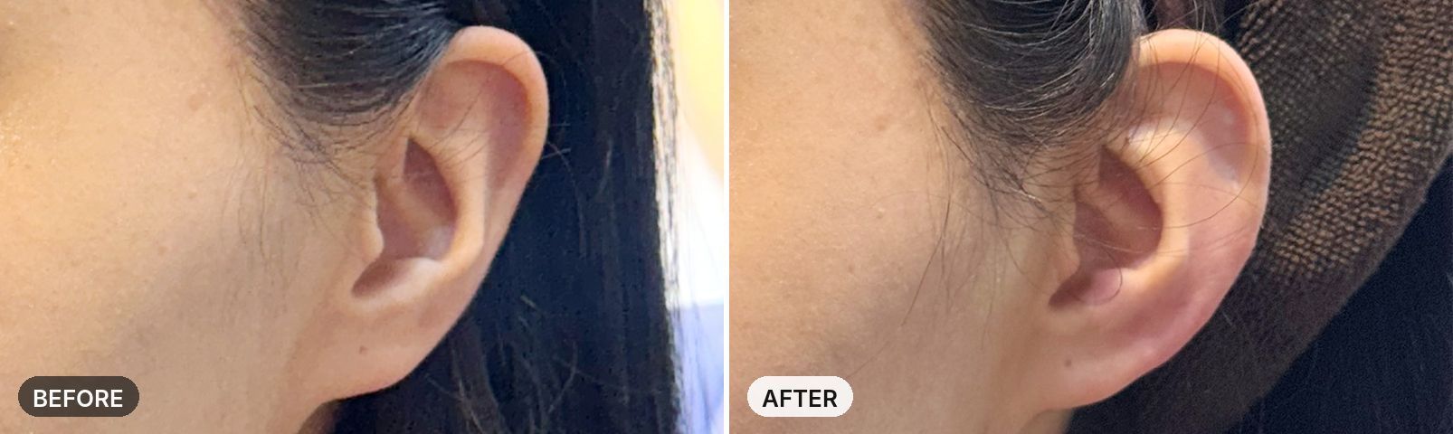 Ear Filler before and after