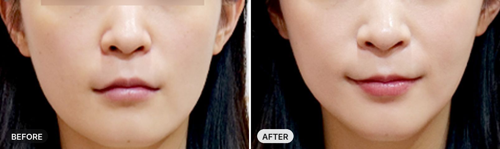 Thermage FLX before and after, case 2, JRYN Seomyeon Busan