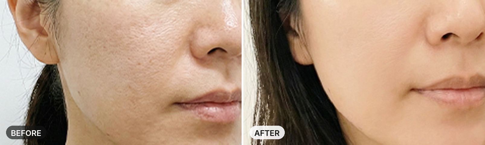 Potenza before and after, case 2, JRYN Seomyeon Busan