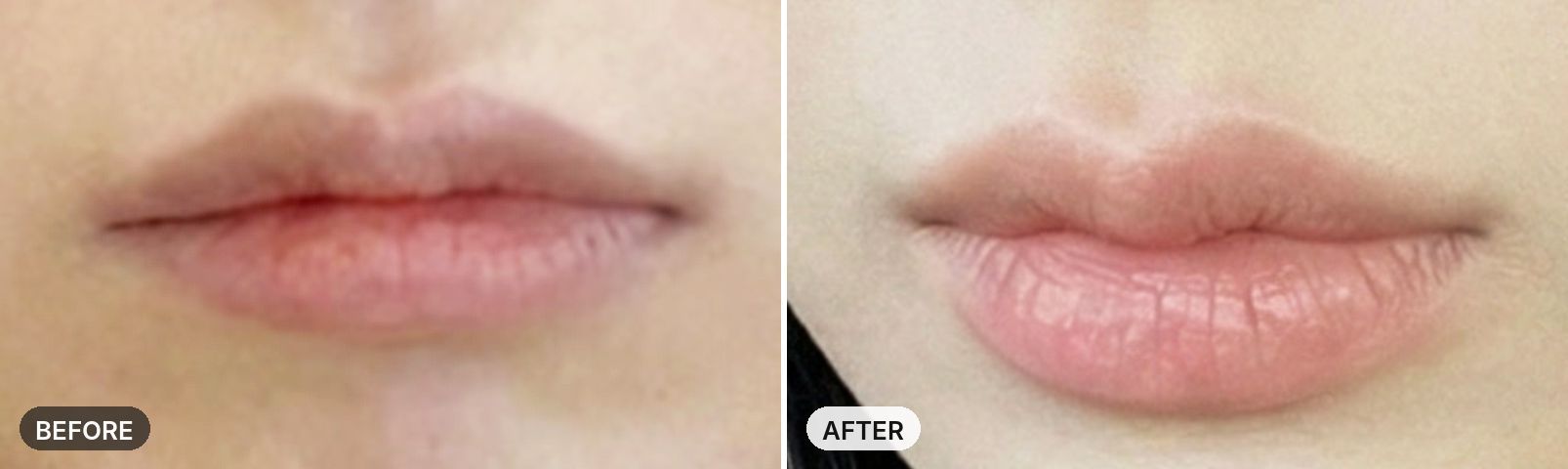 Lip Filler before and after
