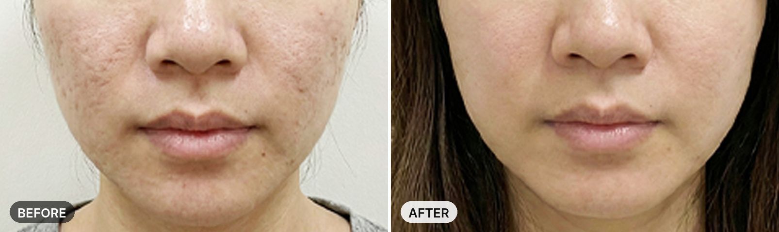 Potenza before and after, case 1, JRYN Seomyeon Busan