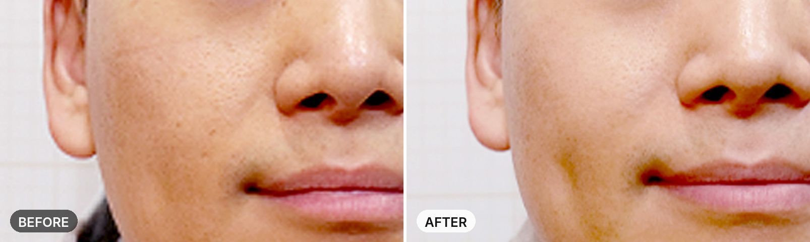 Pico Toning before and after, case 1, JRYN Seomyeon Busan