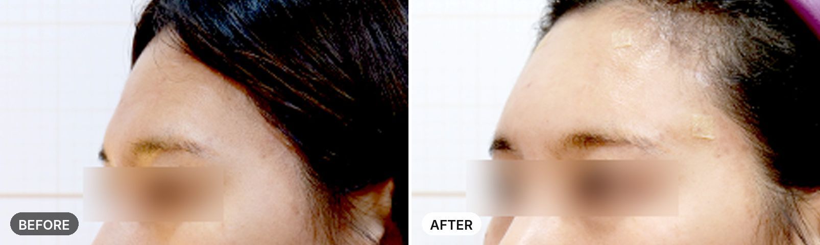 Forehead Filler before and after
