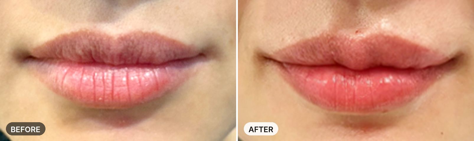 Lip Filler before and after, case 3, JRYN Seomyeon Busan