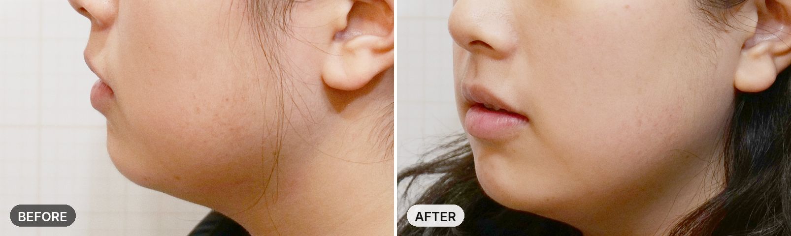 Onda Lifting before and after, case 3, JRYN Seomyeon Busan