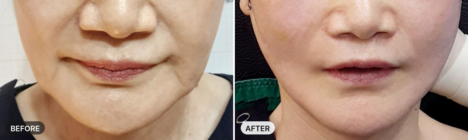Mini Lift before and after, case 1, JRYN Seomyeon Busan