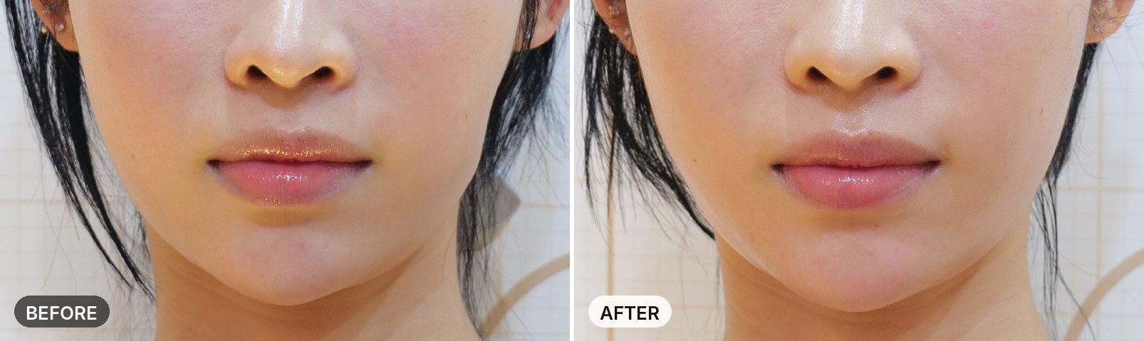 Onda Lifting before and after, case 10, JRYN Seomyeon Busan