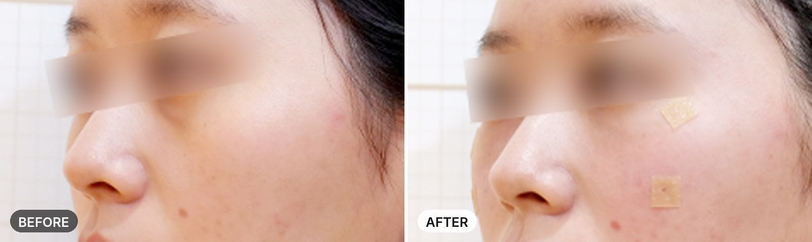 Under-Eye Jamber + Filler before and after