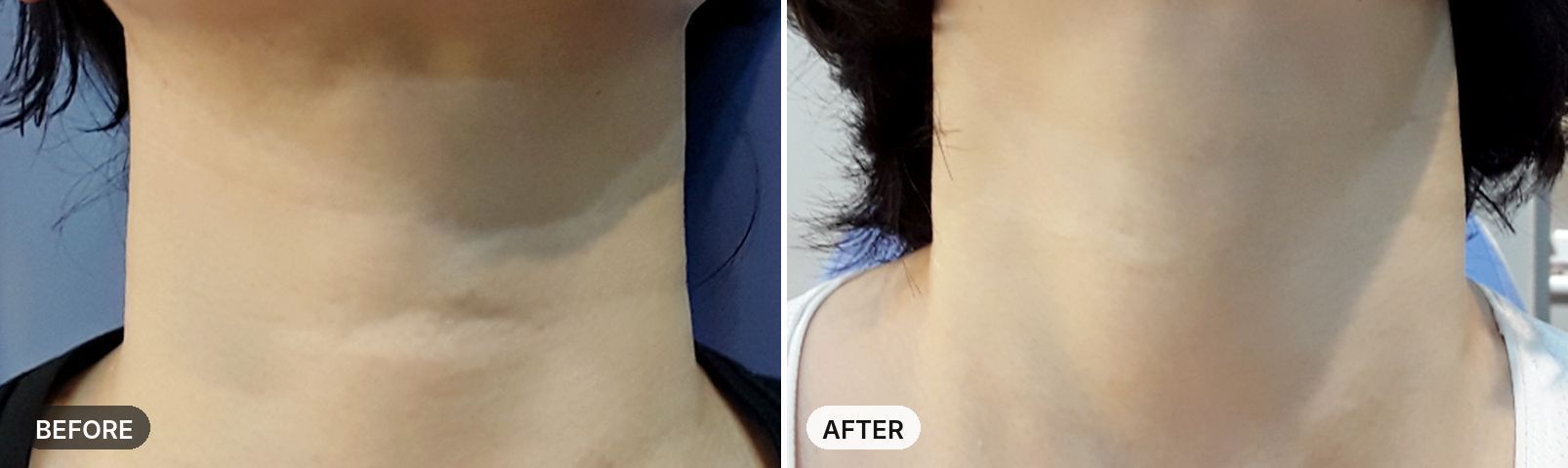 Neck Wrinkle Filler before and after
