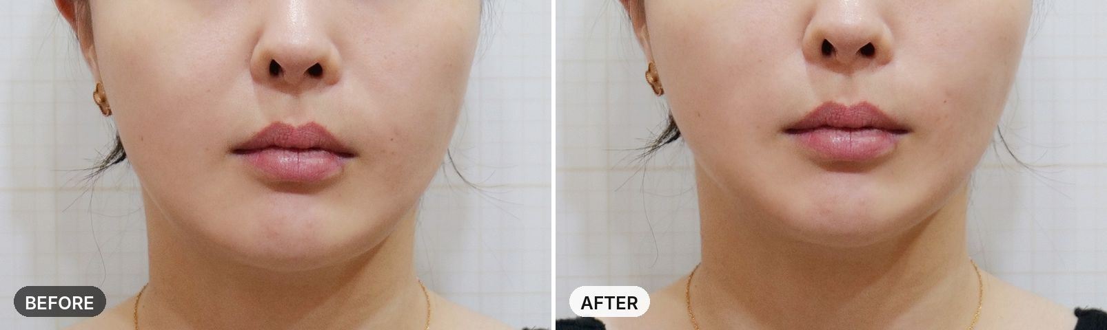 10 Thera + 10 Triple before and after
