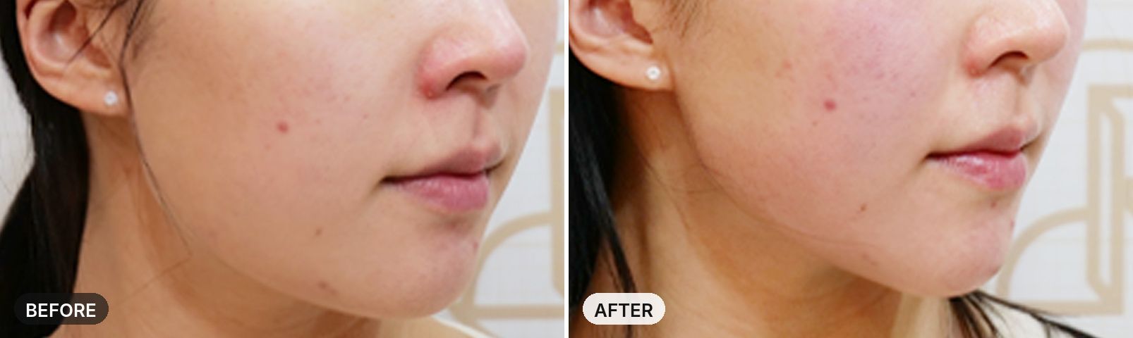 Onda Lifting before and after, case 8, JRYN Seomyeon Busan