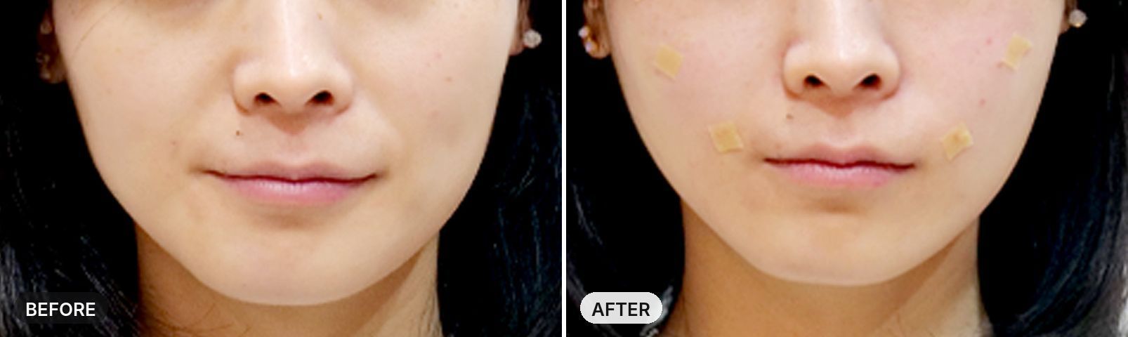Sculptra before and after, case 2, JRYN Seomyeon Busan