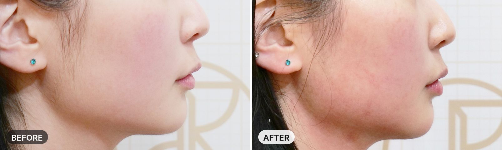 Onda Lifting before and after, case 1, JRYN Seomyeon Busan