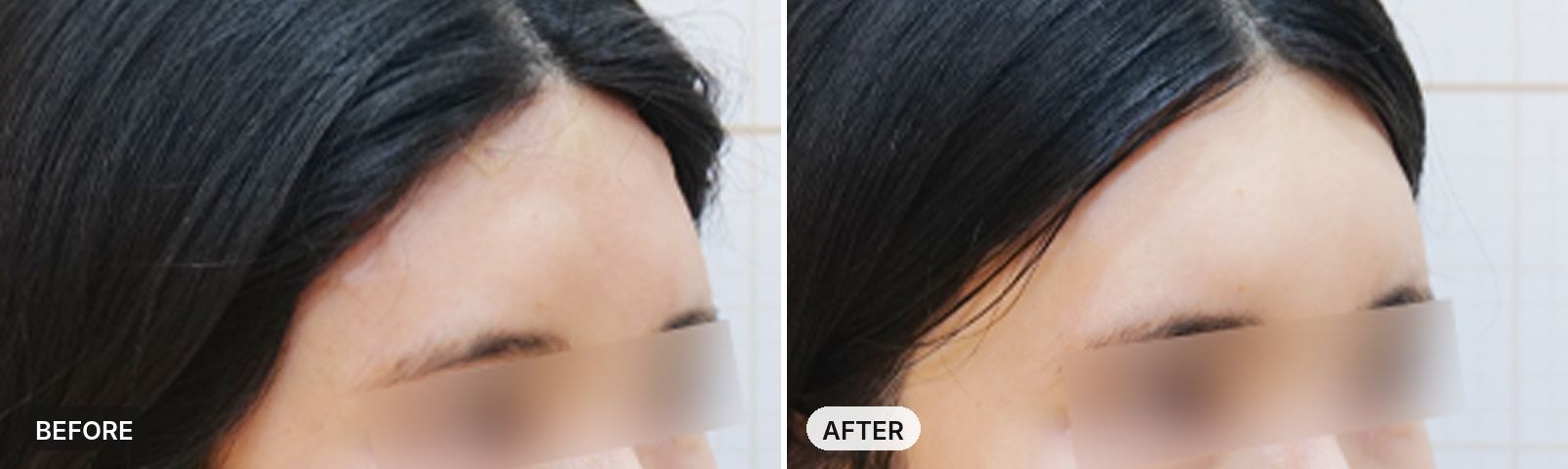 Forehead Filler before and after, case 2, JRYN Seomyeon Busan