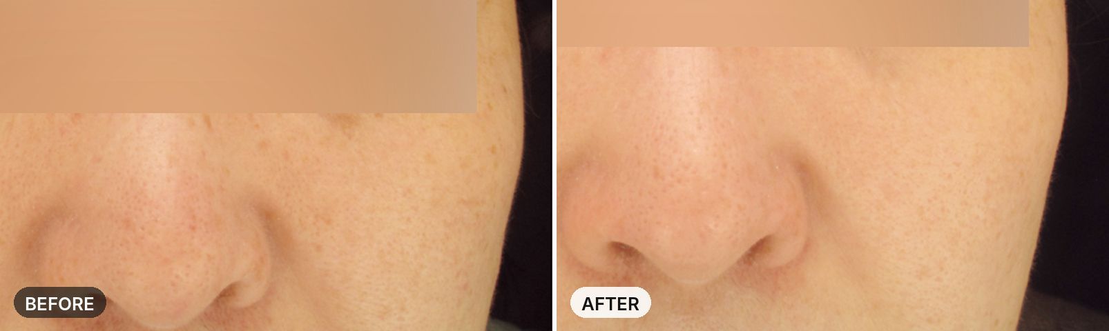 Premium All-in-One Course before and after, case 2, JRYN Seomyeon Busan
