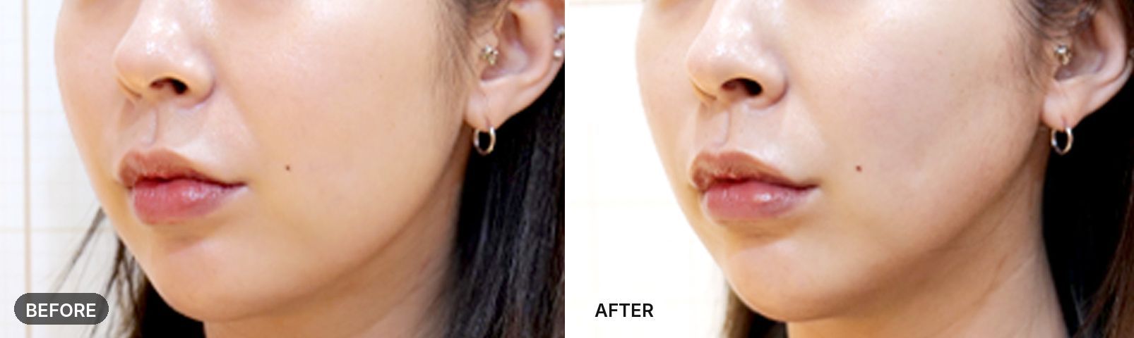 Titanium Lifting before and after, case 6, JRYN Seomyeon Busan