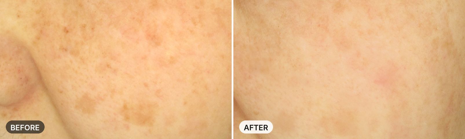Skin Laser before and after, case 4, JRYN Seomyeon Busan