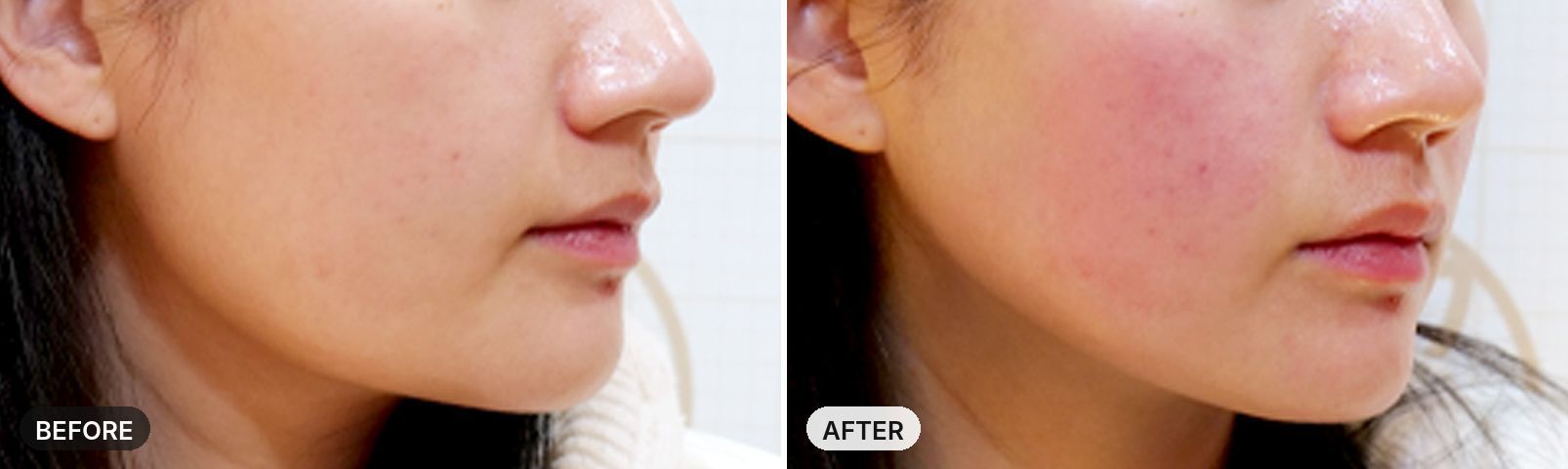 Titanium Lifting before and after, case 2, JRYN Seomyeon Busan