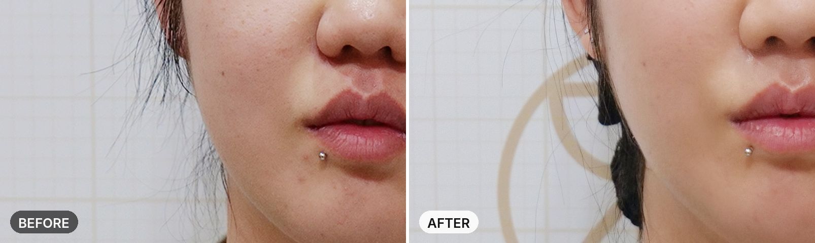 Skin Botox before and after, case 2, JRYN Seomyeon Busan