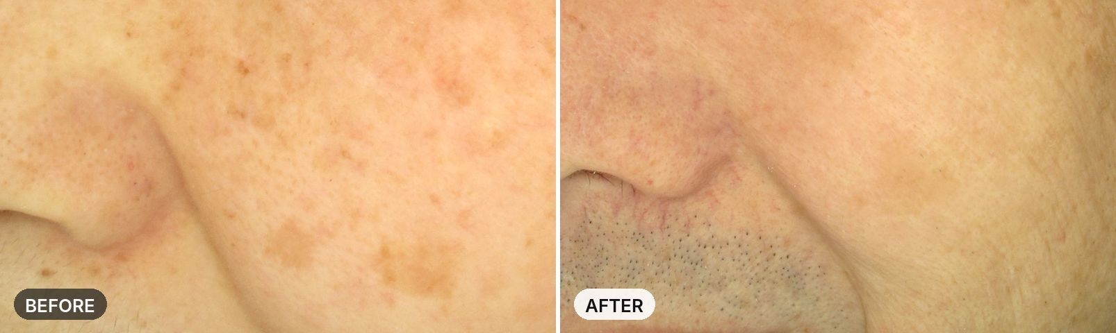 Skin Laser before and after, case 3, JRYN Seomyeon Busan