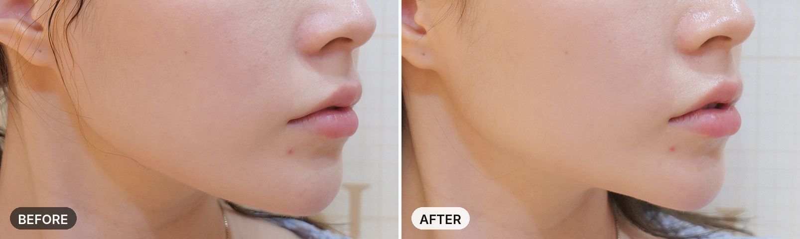 Titanium Lifting before and after, case 15, JRYN Seomyeon Busan