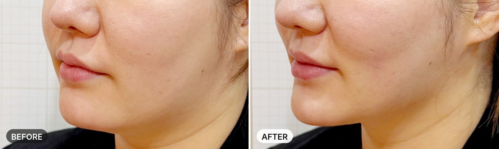 Titanium Lifting before and after, case 13, JRYN Seomyeon Busan