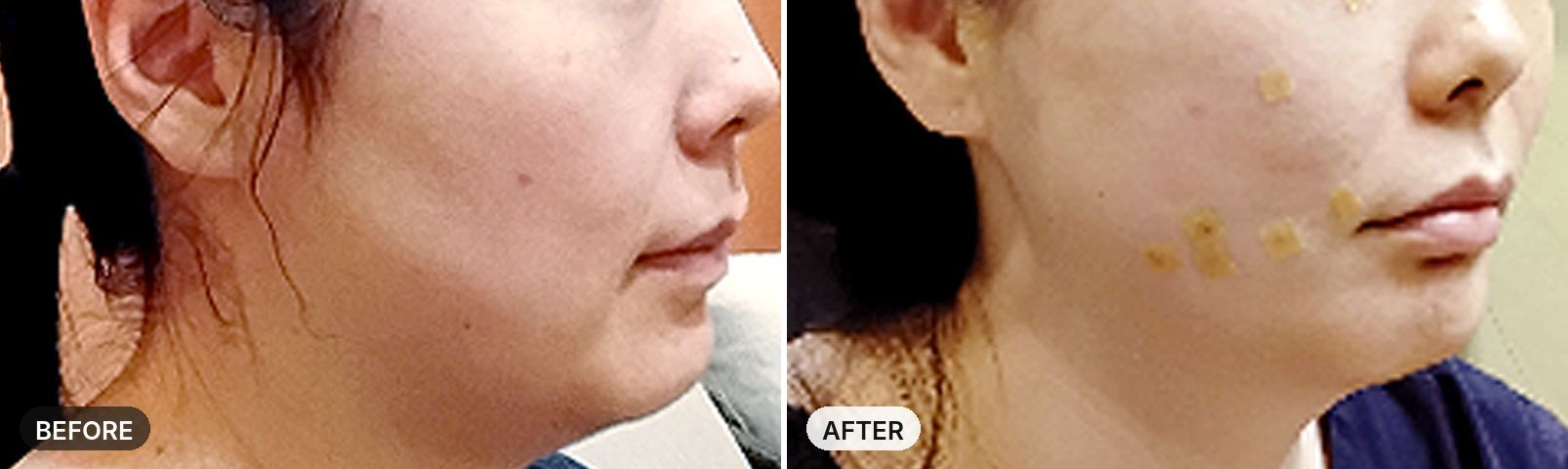 Aptos Thread Lift before and after, case 2, JRYN Seomyeon Busan