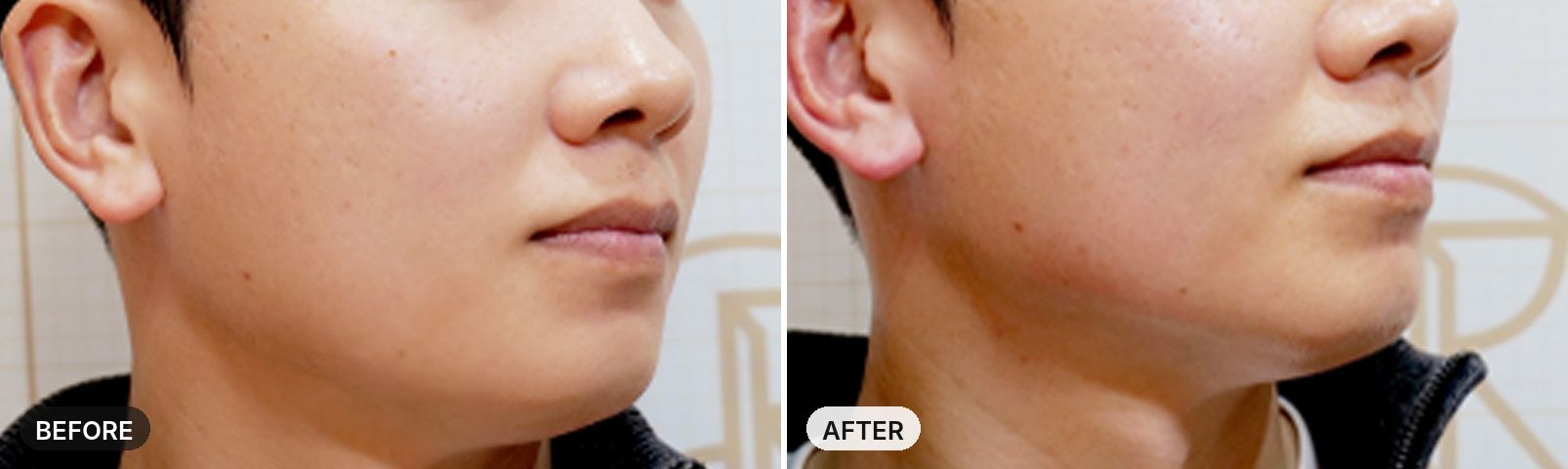 Onda Lifting before and after, case 6, JRYN Seomyeon Busan