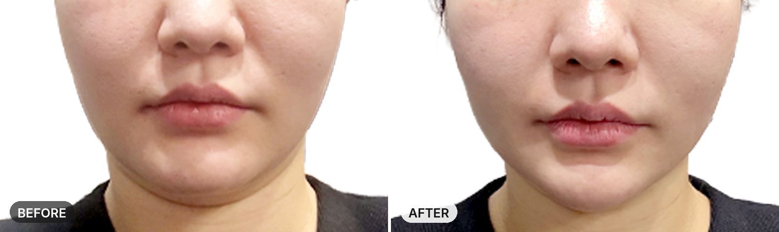 XERF before and after, case 1, JRYN Seomyeon Busan