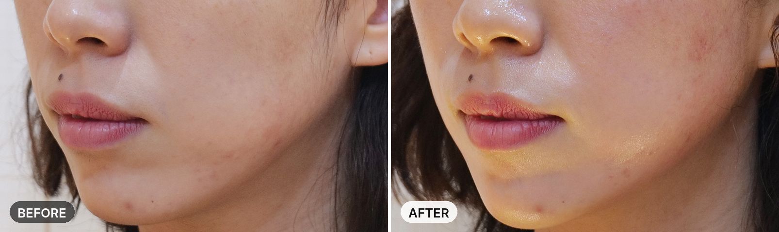 InMode before and after, case 2, JRYN Seomyeon Busan