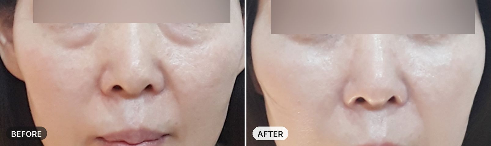 Under-Eye Fat Removal before and after, case 1, JRYN Seomyeon Busan