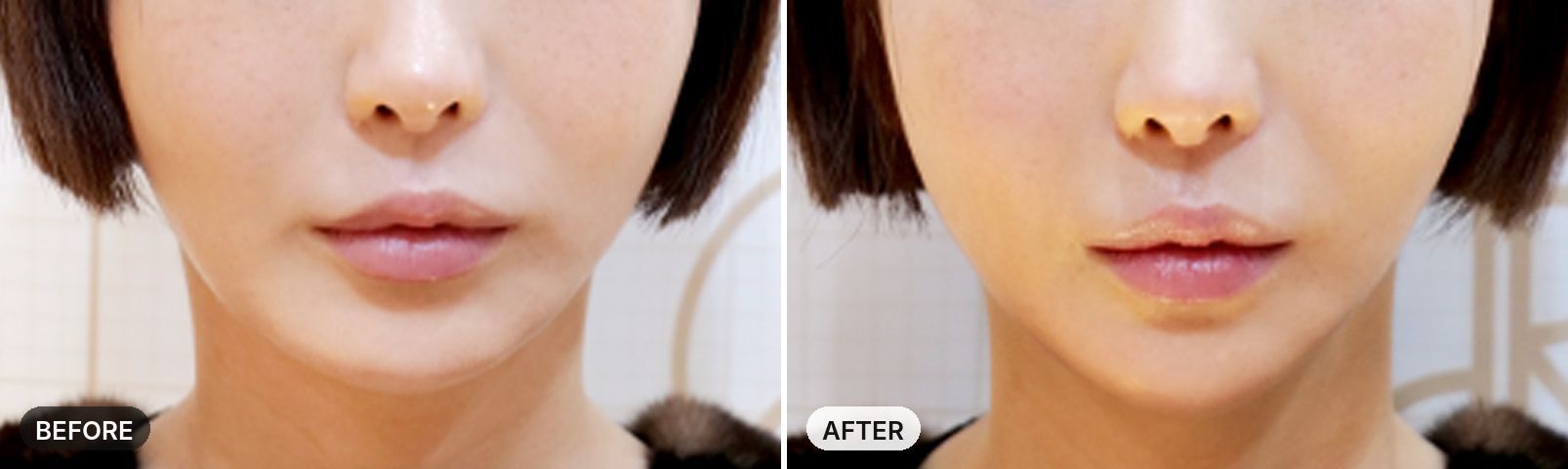 Titanium Lifting before and after, case 8, JRYN Seomyeon Busan