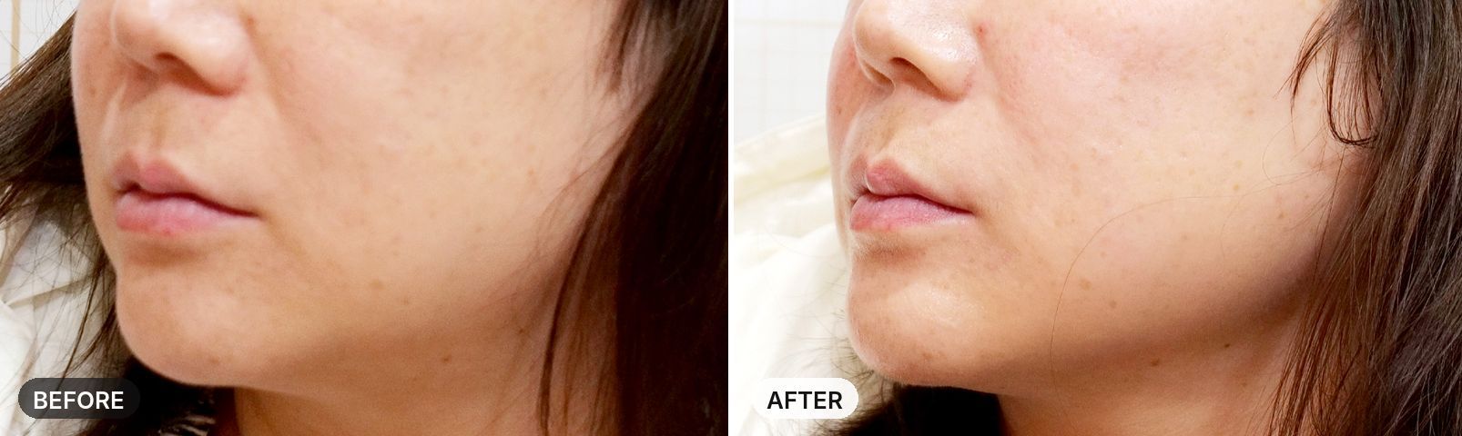 Onda Lifting before and after, case 4, JRYN Seomyeon Busan