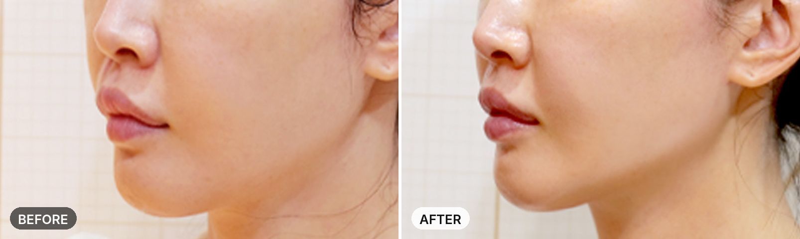 Titanium Lifting before and after, case 9, JRYN Seomyeon Busan