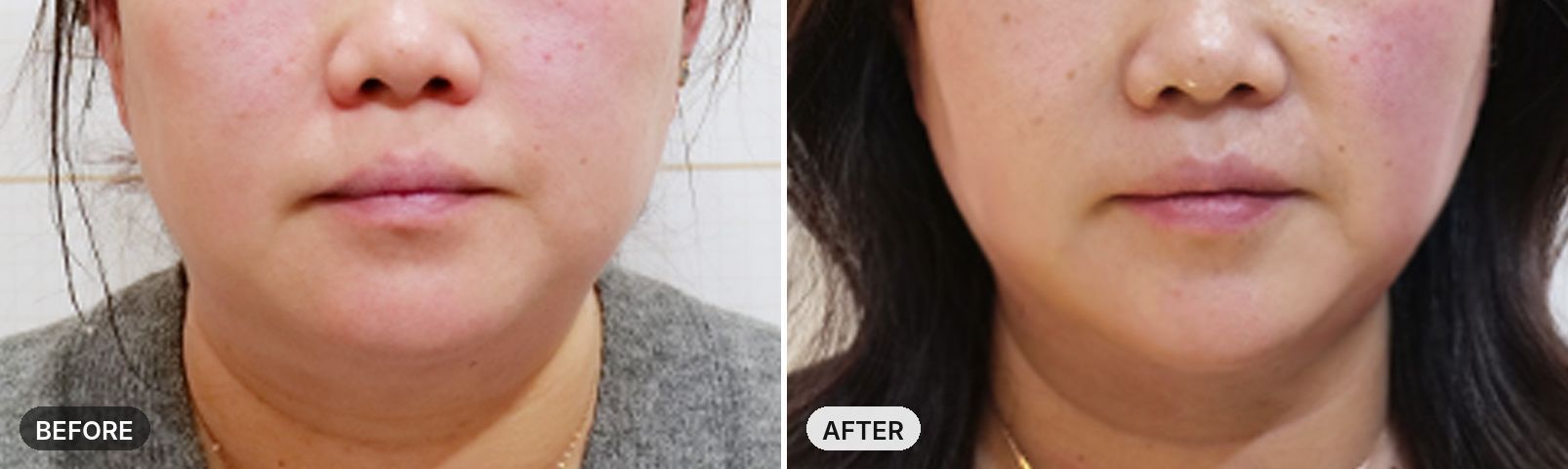 Onda Lifting before and after, case 7, JRYN Seomyeon Busan
