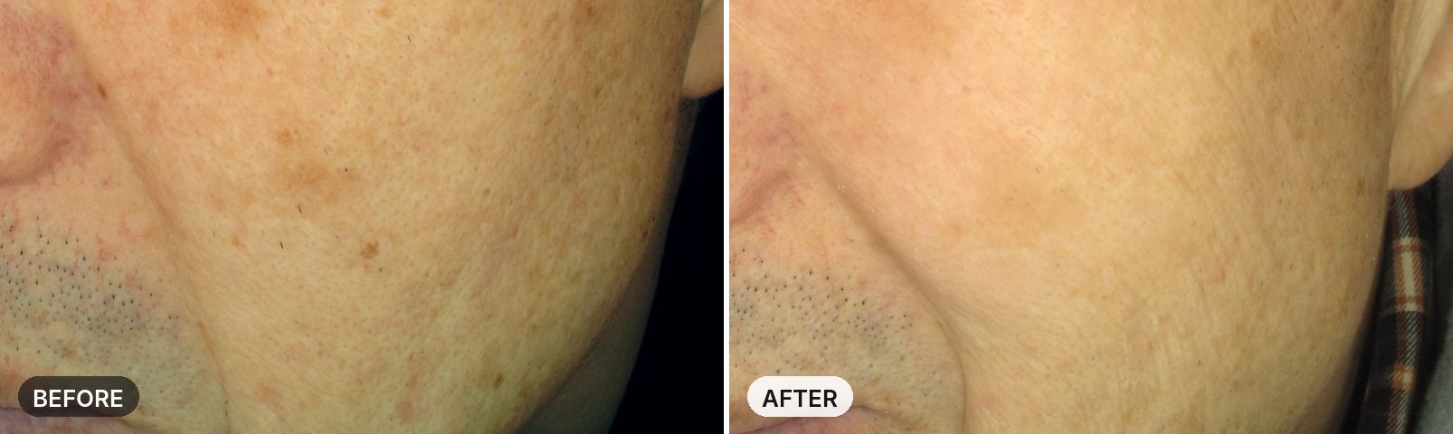 Skin Laser before and after, case 2, JRYN Seomyeon Busan