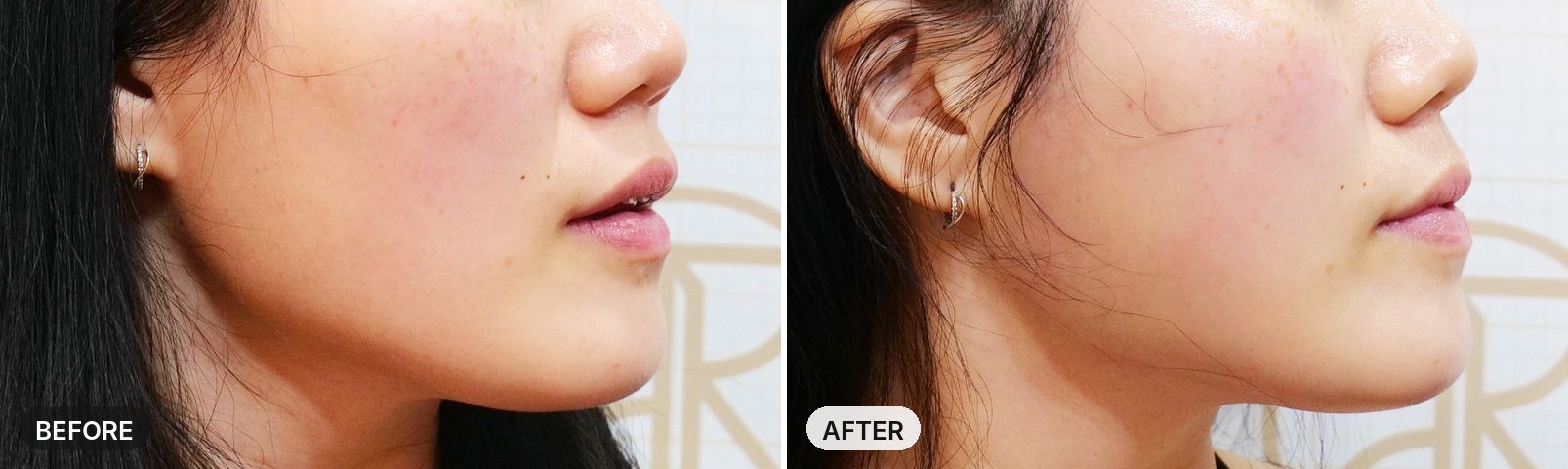 Onda Lifting before and after, case 5, JRYN Seomyeon Busan