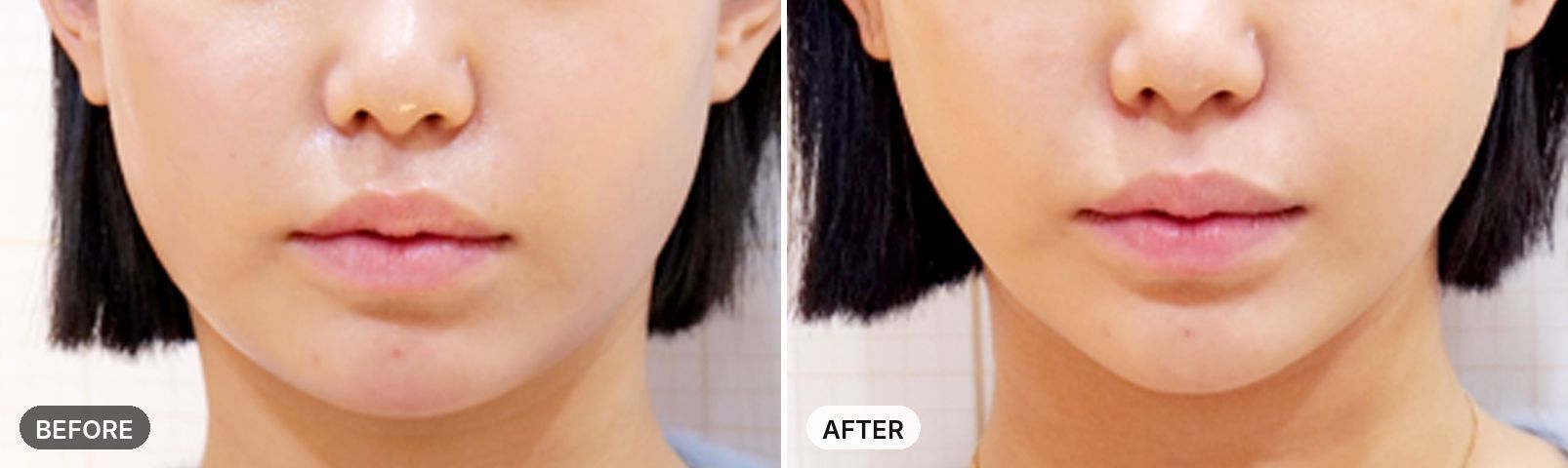 Titanium Lifting before and after