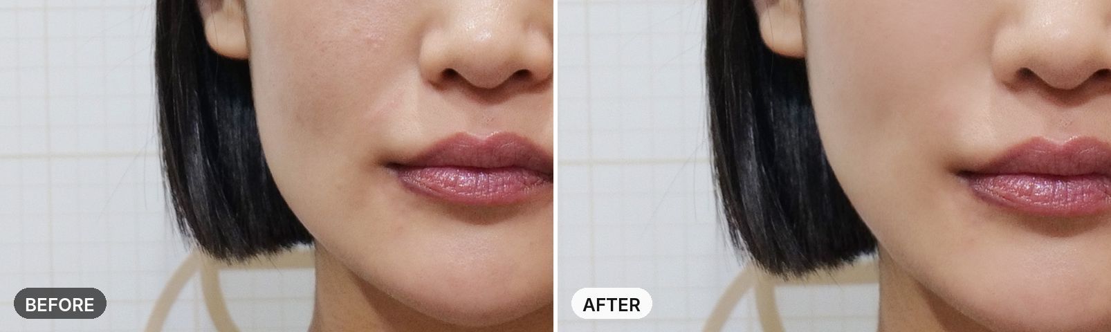Skin Botox before and after, case 1, JRYN Seomyeon Busan