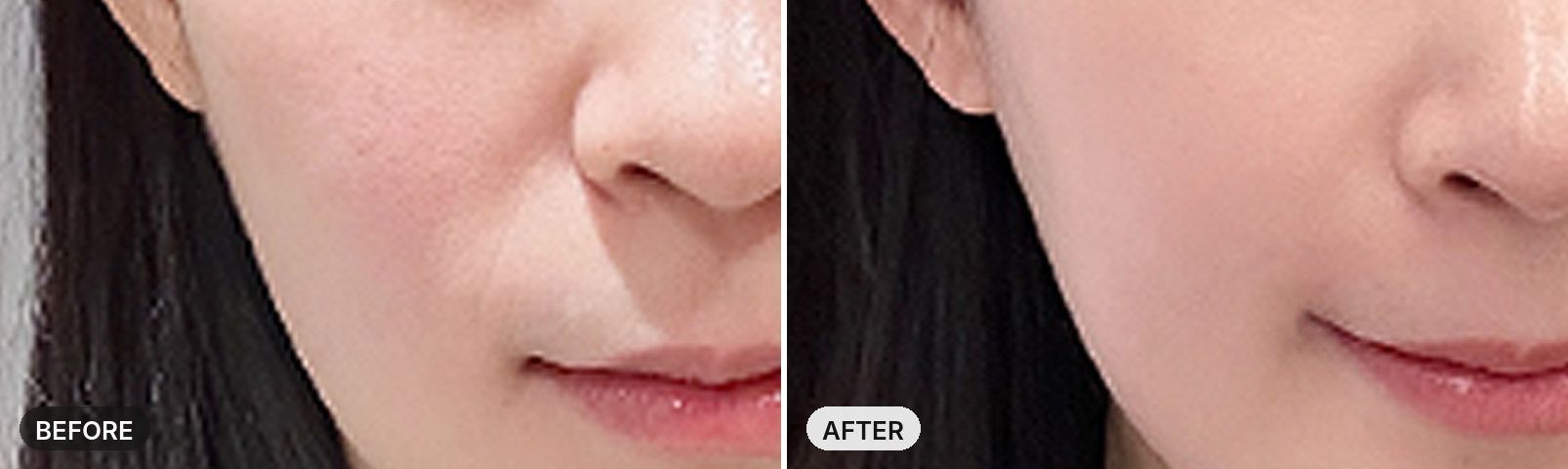 Sculptra before and after, case 1, JRYN Seomyeon Busan