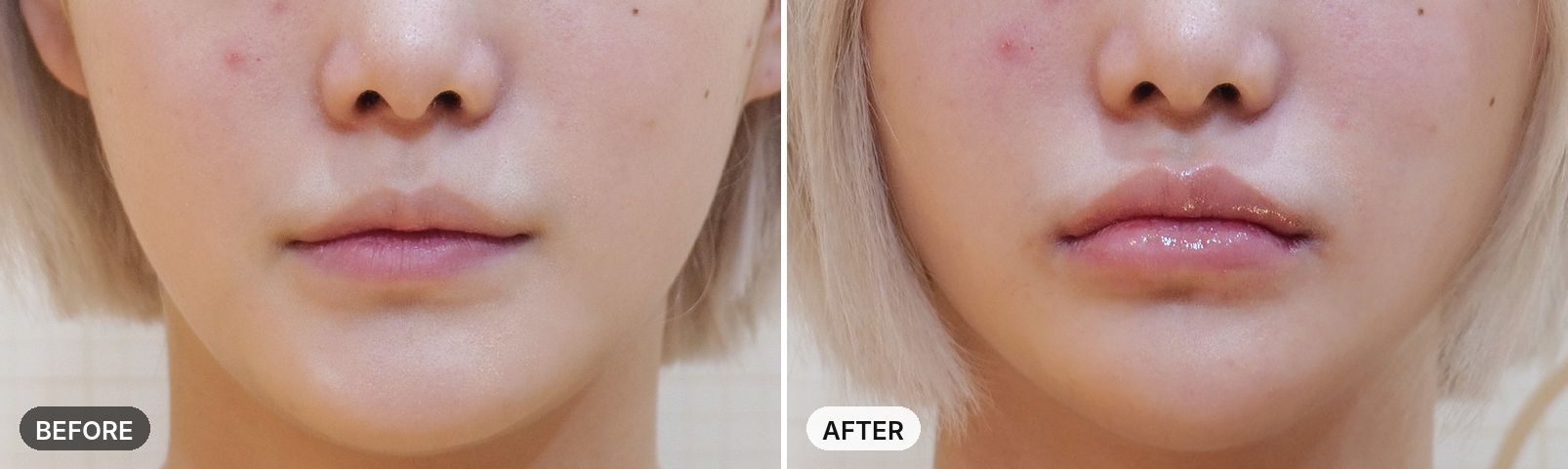 InMode before and after, case 1, JRYN Seomyeon Busan