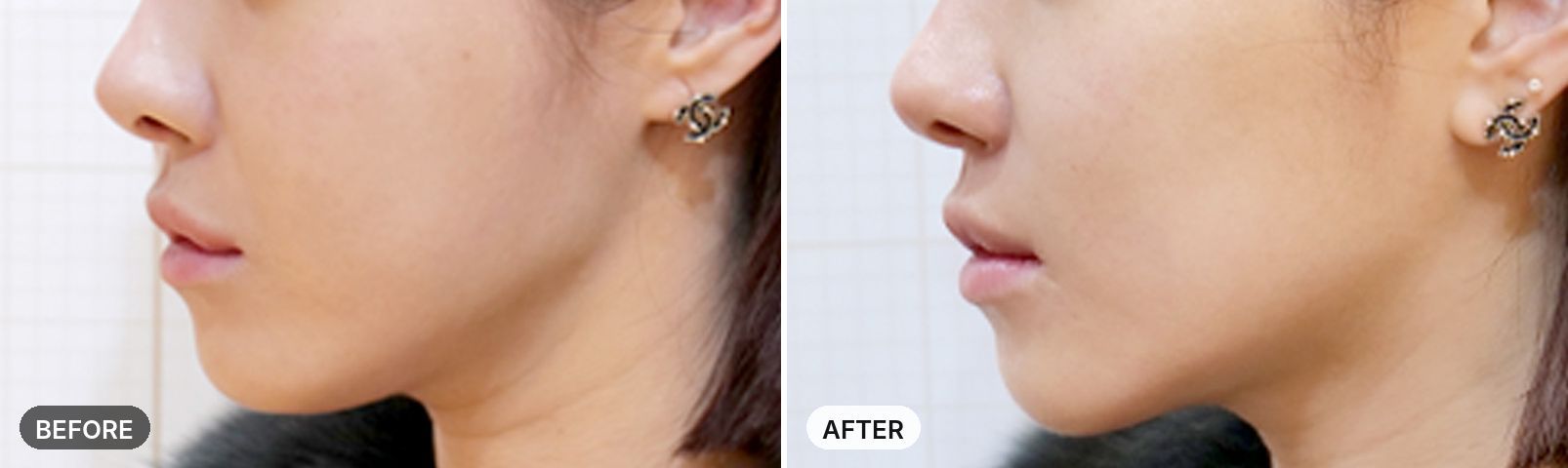 Titanium Lifting before and after, case 7, JRYN Seomyeon Busan