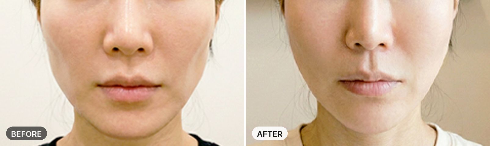 Side Cheek Filler before and after