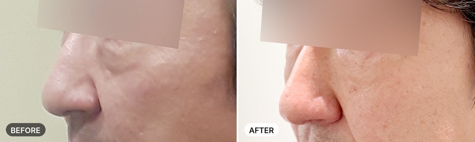 Under-Eye Fat Removal before and after, case 2, JRYN Seomyeon Busan