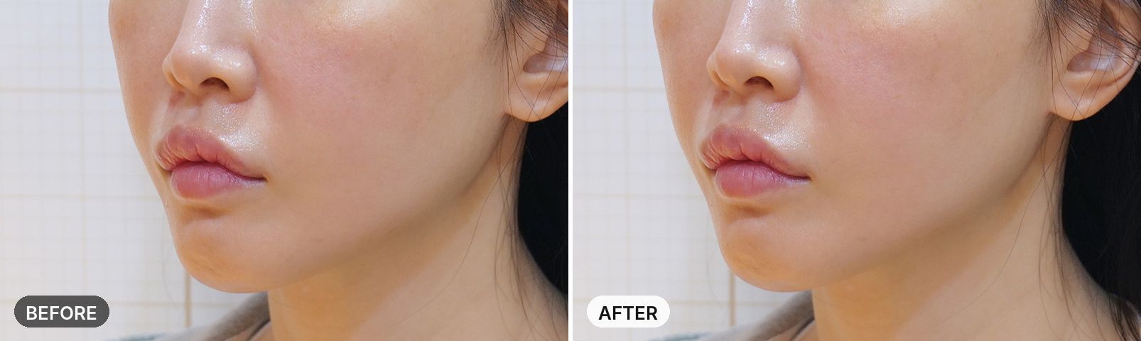 Titanium Lifting before and after, case 16, JRYN Seomyeon Busan