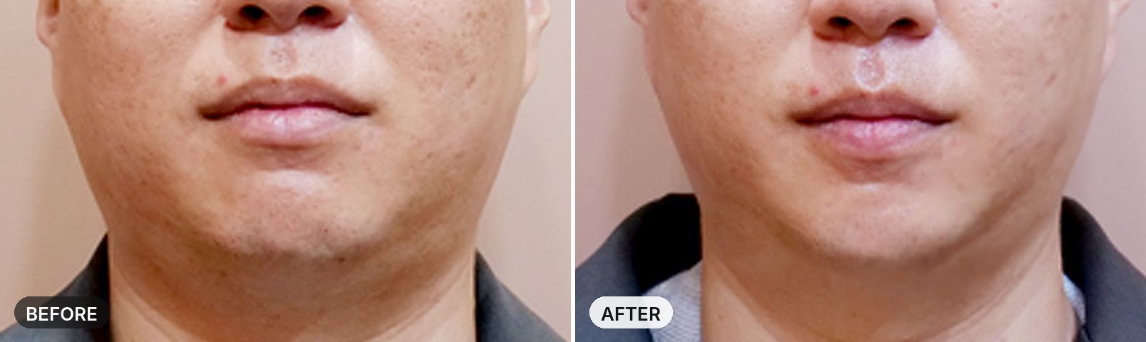Titanium Lifting before and after, case 12, JRYN Seomyeon Busan