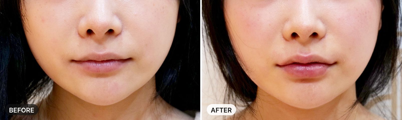Onda Lifting before and after, case 2, JRYN Seomyeon Busan