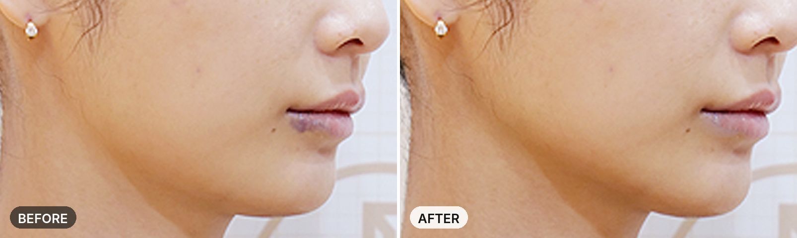 Titanium Lifting before and after, case 10, JRYN Seomyeon Busan