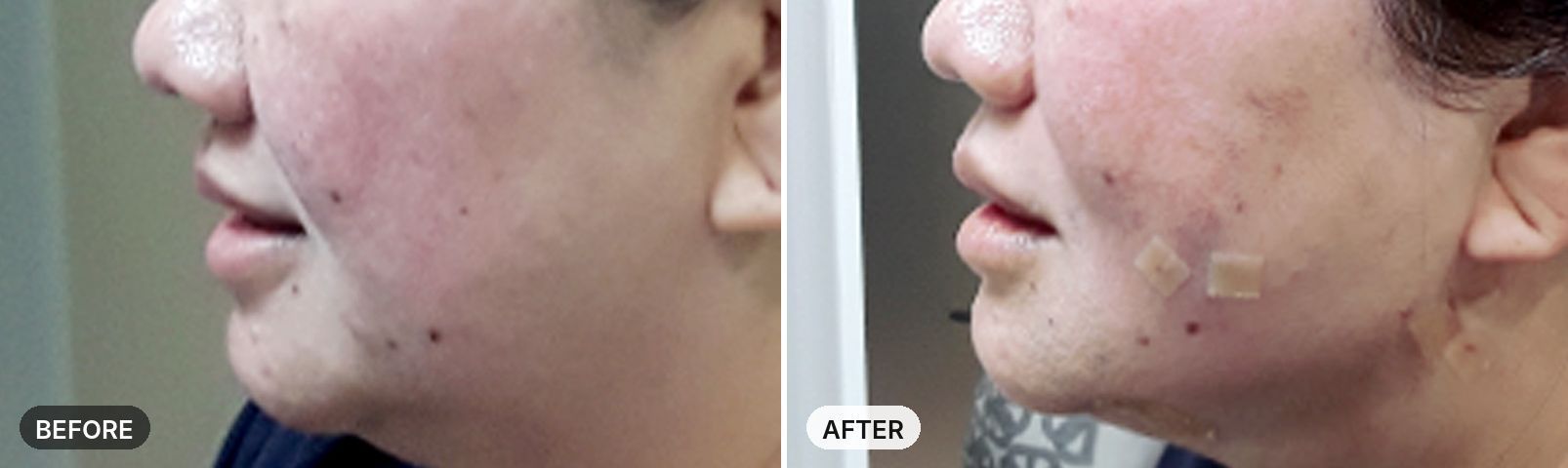 Aptos Thread Lift before and after, case 3, JRYN Seomyeon Busan