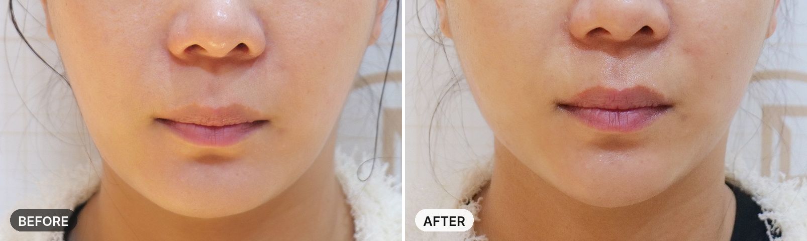 Titanium Lifting before and after, case 14, JRYN Seomyeon Busan